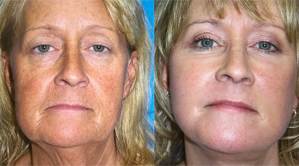 Before & After Regenerative Medicine Results By Mission Wellness