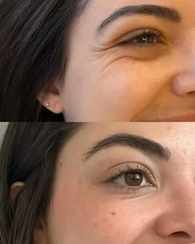 Botox & Dysport