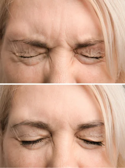 Before and After Laser Treatment Results