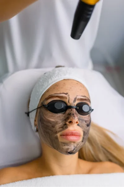 Carbon Laser Facial