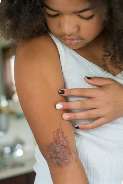 Pigmented Lesion Treatment