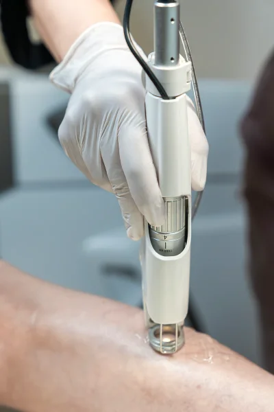 Spider Vein Removal