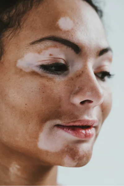 Sun Spot Removal